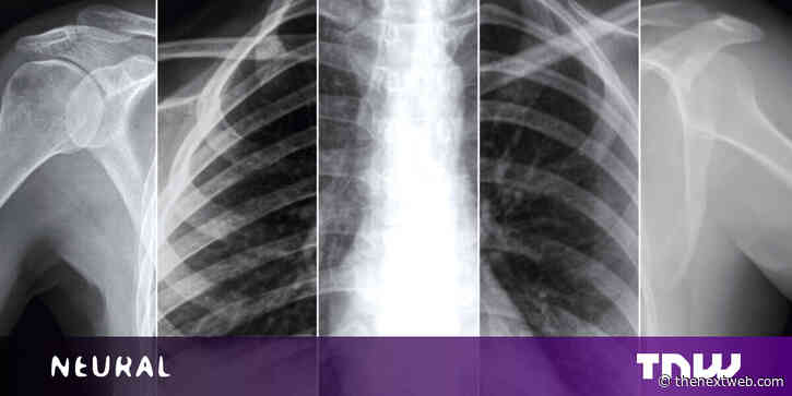 New self-supervised AI models scan X-rays to predict prognosis of COVID-19 patients