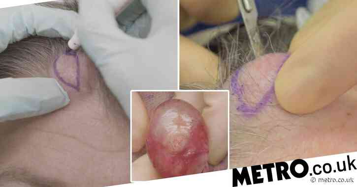 Giant head cyst explodes in doctor’s hands in extreme graphic pimple popping video