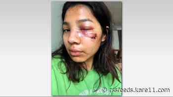 Minneapolis settles lawsuit with injured demonstrator