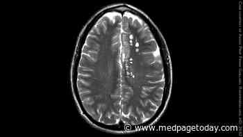 Dementia Tied to Large Perivascular Spaces