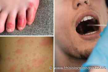 Full list of Covid symptoms - including Covid tongue