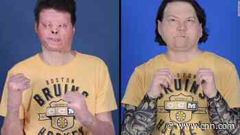 Man receives first successful face and double hand transplant
