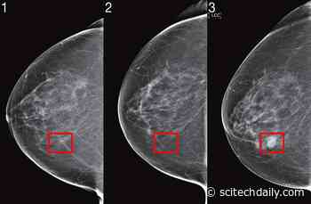 MIT Mirai: Robust Artificial Intelligence Tools To Predict Future Cancer