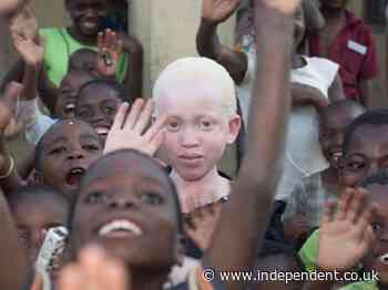 ‘Chilling’ resurgence of killings and kidnappings of people with albinism in Malawi, Amnesty warns