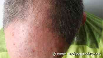 Want Data on Recently Approved Actinic Keratosis Drug? Here You Go