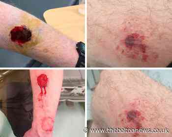 Special constable suffers serious bite marks during police raids