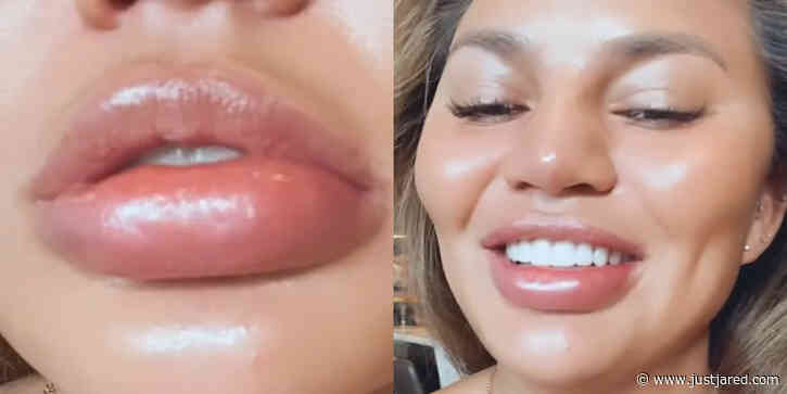 Chrissy Teigen Swears She Did Not Get Lip Fillers, Shows Off Her Swollen Lip From an Allergic Reaction