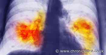 ADVERTORIAL: Non-smoker's lung cancer spotted in 'one-in-a-million' scan