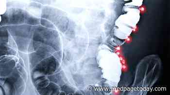 Antibiotic Duo Wins in Diverticulitis Outpatient Tx