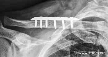 How speech to text, password managers and other tech helped me work with a broken collarbone     - CNET