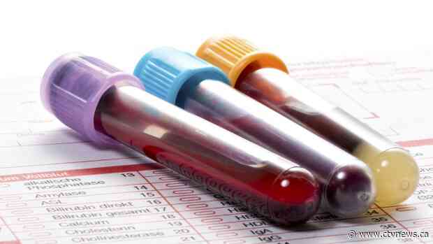 Blood tests could be early indicator of COVID-19 severity: study