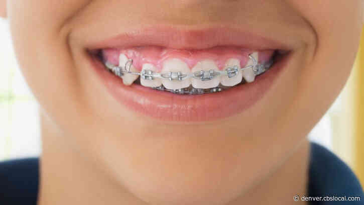 Orthodontist Kept Children In Braces Longer Than Necessary, Massachusetts AG Alleges In Lawsuit