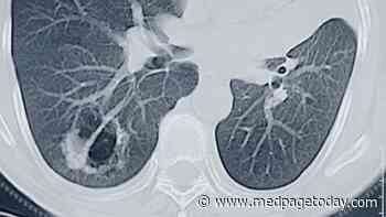 USPSTF Expands Lung Cancer Screening Criteria