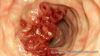 New Guideline Lowers Age to Begin Colorectal Cancer Screening