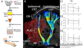 Injecting Bone Marrow Cells Helps Heal the Brain After Stroke