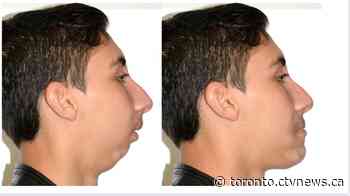 Pakistani teen who had to eat through a straw receives one-of-a-kind surgery in Toronto