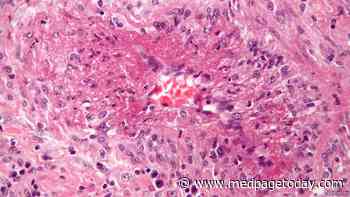 Serious Infections Still Common in Vasculitis
