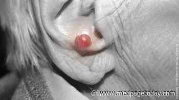 Margin Size, Radiation Tied to Survival in Merkel Cell Carcinoma