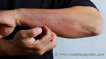 Atopic Dermatitis Responds to Novel JAK Inhibitor