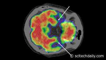 Stressed Brain Linked to “Broken Heart” Syndrome