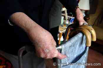 Prescription drug linked with reduced dementia risk in arthritis patients - Barrhead News