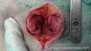 Unusual Presentation of Rare Aggressive Cancer