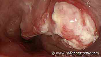 Practice Change Needed for Gastroesophageal Cancer?