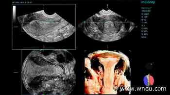 Medical Moment: Docs see deeper with new ultrasound - WNDU-TV