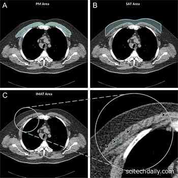Chest CT Scans Illuminate Mortality Risk in People With COPD