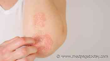 Biosimilars Match Up With Originals for Skin Disorders