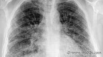 Transplant recipient unknowingly gets coronavirus infected lungs, dies two months later - WISHTV.com