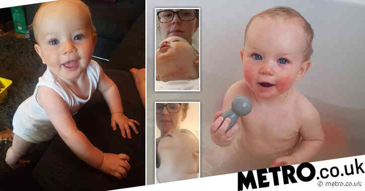 Mum whose baby’s skin was ‘on fire’ for months praises £10 cream for eczema transformation