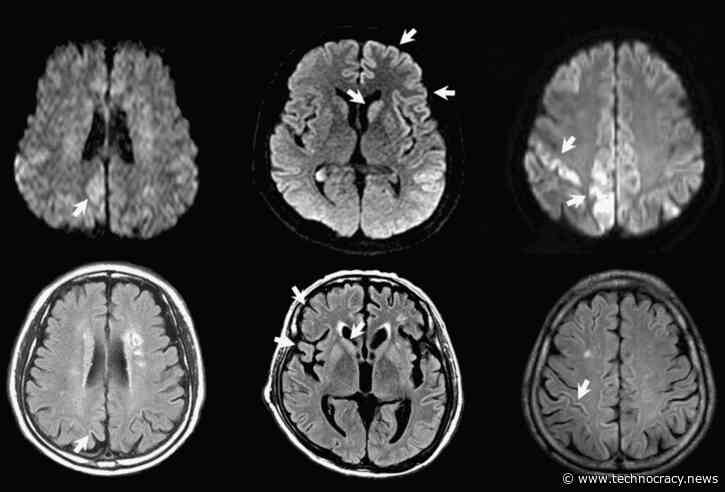 Study: mRNA-Based Vaccines And The Risk Of Prion Disease