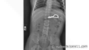 Minneapolis-area hospitals see rise in children swallowing magnets