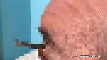 Un chiodo nell’occhio mentre taglia l’erba. Per i medici è un «danno da lockdown» - L'Arena