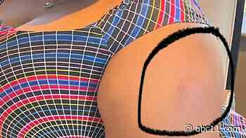 UNC joins national effort to study allergic reactions to COVID mRNA vaccines