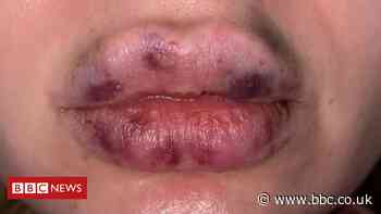 Lockdown lip fillers gone wrong: 'My lips went black'