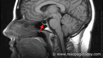 Bariatric Surgery Promising in Idiopathic Intracranial Hypertension