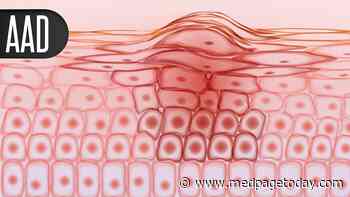 Rapid Improvement in Atopic Dermatitis With Topical JAK Inhibitor