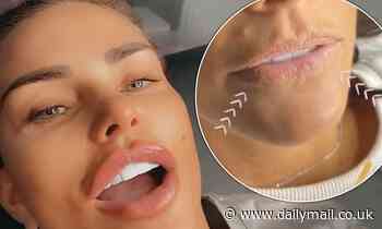 Katie Price reveals what her lips look like after having filler dissolved then gets pout re-plumped