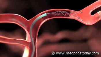 This Is How Much Every Second Counts in Stroke Thrombectomy