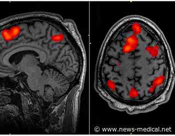 Neuroimaging technology used to study how brain stimulation works for treatment of depression