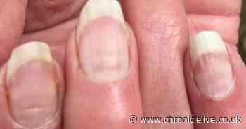 'Covid nails' could be a sign you had coronavirus before