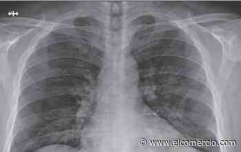 Un tercio de ingresados por covid presentan cambios pulmonares dentro de un año después