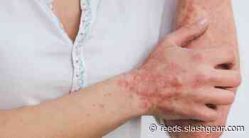 Intermittent fasting protocol found to reduce psoriasis after a few weeks