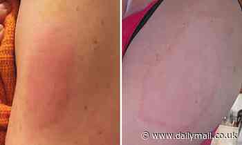 'Covid arm' side-effect from Moderna vaccine is HARMLESS and disappears within a week, study finds
