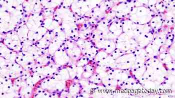 How Did a Patient Survive a Decade With Metastatic RCC?