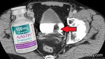 Bevacizumab Misses Mark in Untreated Metastatic Bladder Cancer
