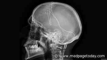 How Long Do Deep Brain Stimulation Benefits Last?