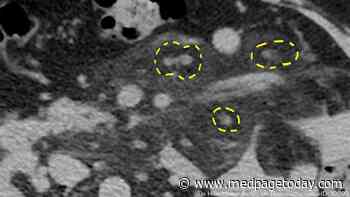 Diabetic Man With Sclerosing Mesenteritis Experiences Glycemic Control With Steroids